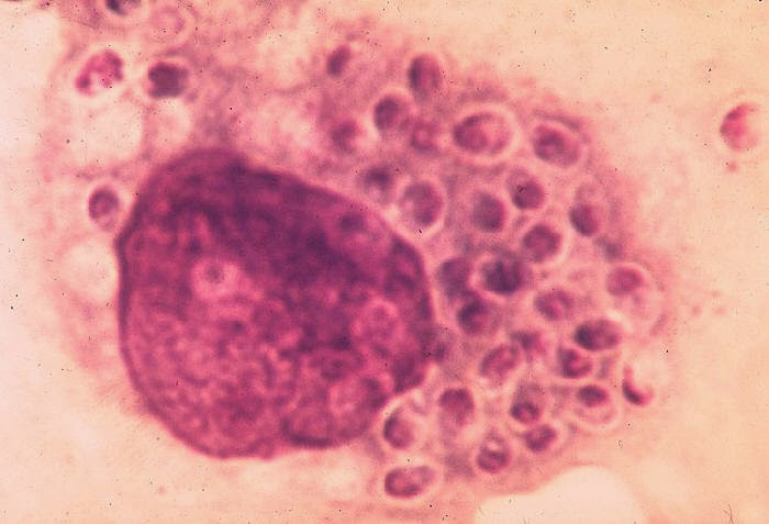 Histiocyte (macrophage) filled with Histoplasma.