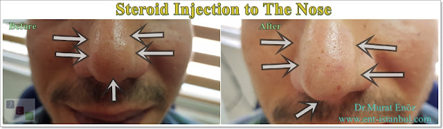 Steroid injection after rhinoplasty