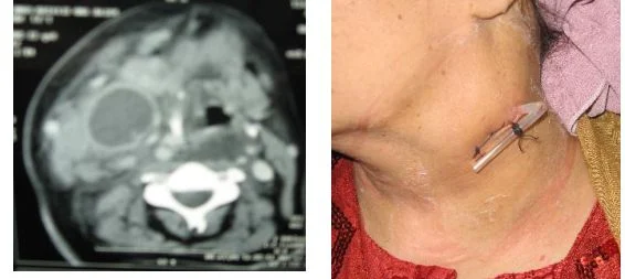 Parapharyngeal-Abscess