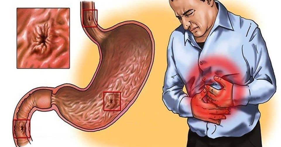 10 Tips Doktor: Cara Elak Sakit Gastrik Semasa Puasa 