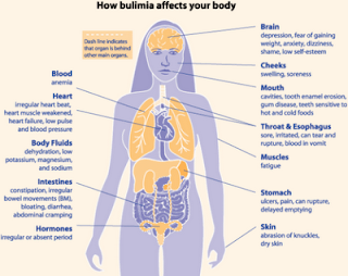 Eating Disorders Bulimia