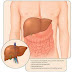 Hepatitis C es curable si se diagnostica oportunamente