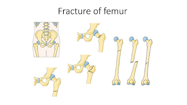 femur-fracture-treatment-femur-bone-fracture-surgery