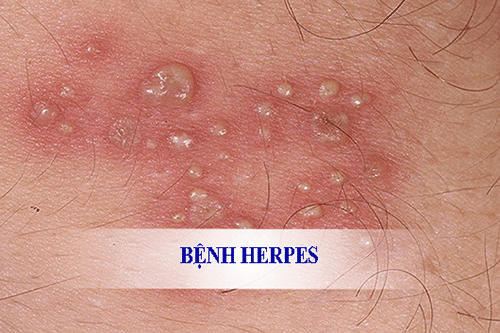 Herpes simplex gây ra những bệnh nào?