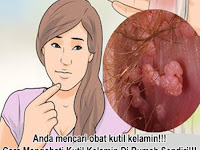 Obat Kutil Kelamin Natural Manjur