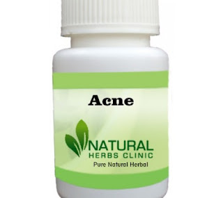 Herbal Product for Acne