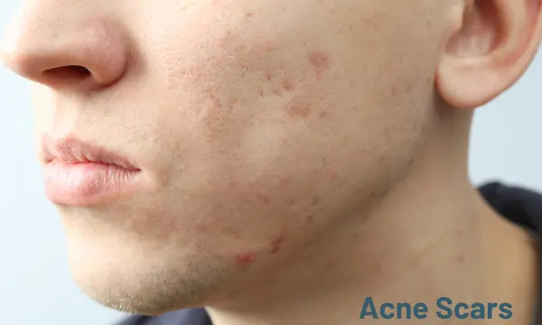 5 Ways to Fade Acne Scars Fast