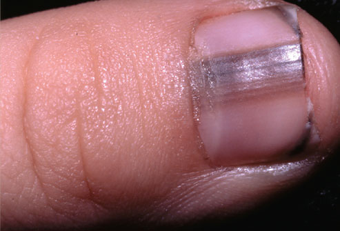 Melanoma Under Nail Treatment