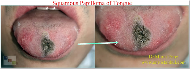 Squamous Papilloma of Tongue HPV oral infection