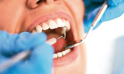 Quy trình bọc răng sứ cho răng lệch