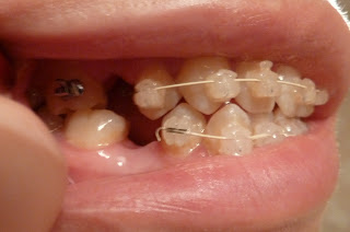 A side on photograph of teeth with ceramic fixed braces at week 4 of treatment