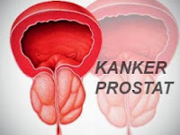 pengobatan kanker Prostat alami