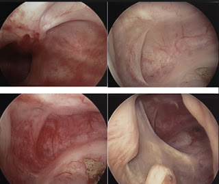 Bladder Cancer Pictures From Cystoscopy