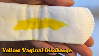 What Causes Vaginal Discharge: Normal,  Abnormal and Colors of Vaginal Discharge