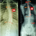 脊椎側彎矯正案例23- 26歲密集治療16.5天 胸椎側彎35度降為25度