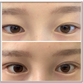 operasi mata, operasi lipatan mata, double eyelid, mata segar, mata besar, mata sayu, operasi korea, dokter korea, jenis operasi mata, sudut mata, tarik otot, ptosis