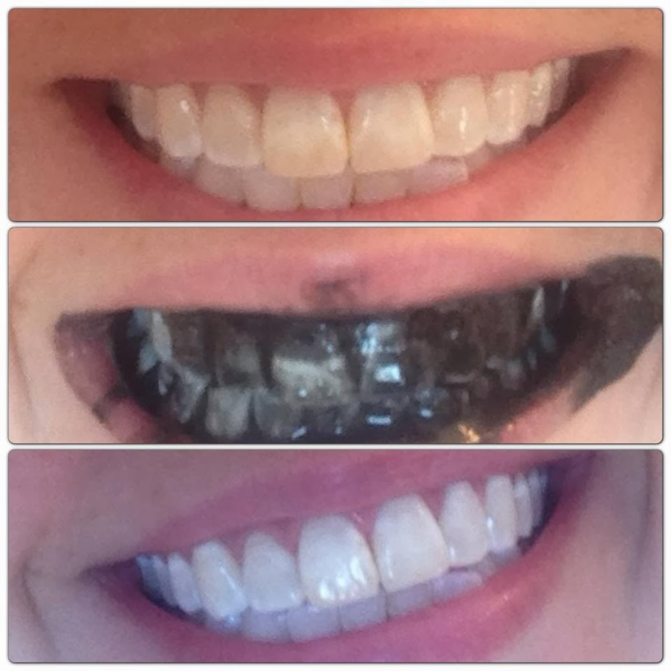 Before And After Teeth Whitening With Baking Soda Natural 