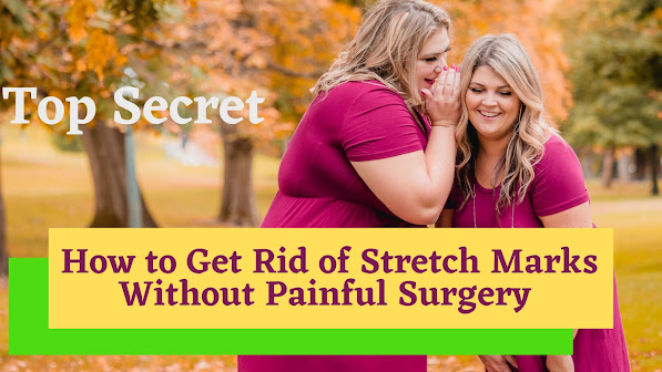 stretch marks painless tretment