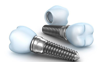 Trồng răng số 7 bằng phương pháp cấy ghép implant-3