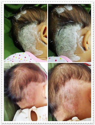 bedak ruam bayi, ruam bayi powder, penyakit kulit, penawar eczema, penawar psoriasis, ruam kulit bayi