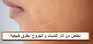 تخلص من اثار الندبات و الجروح  بطرق طبيعية