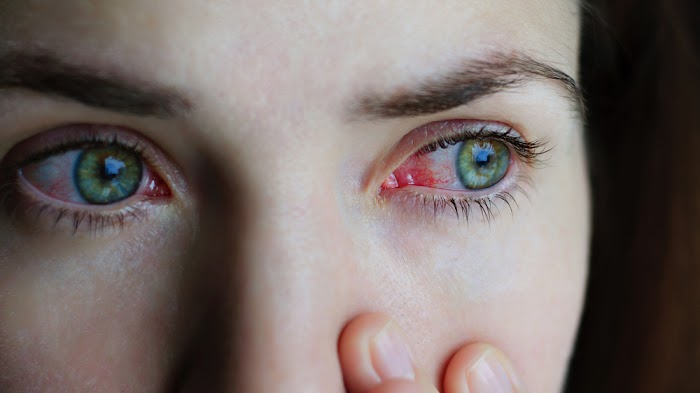 Pink Eye (Conjunctivitis) Symptoms, Causes, Treatments