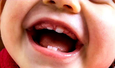 Acceleration of teething in children   تسريع التسنين عند الأطفال