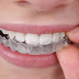 Quy trình niềng răng không mắc cài invisalign