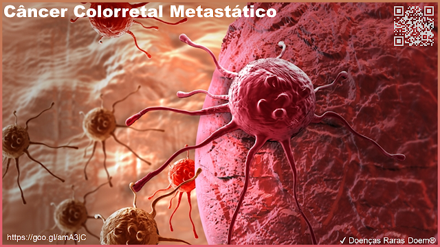 Câncer Colorretal Metastático