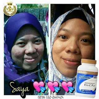 Maksud Jerawat Berdasarkan Kedudukan di Muka, Penyebab Jerawat, Punca Jerawat, Cara Megatasi Jerawat, Cara Hilangkan Jerawat, Supplemen untuk Jerawat, Vitamin untuk Kulit Cantik, Set Kecantikan Shaklee, Petua Kulit Cantik, Rahsia Kulit Cantik, Sustained Release Vita-C Plus Shaklee, Testimoni Sustained Release Vita-C Plus Shaklee, 