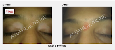 Vitiligo treatment and Leucoderma