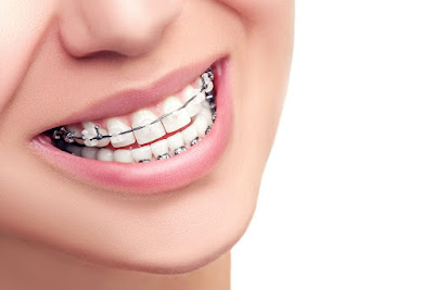 Niềng răng mắc cài sứ mang lại lợi ích gì?