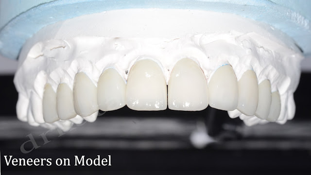 Dental veneers on model