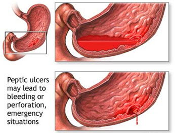 gastritis