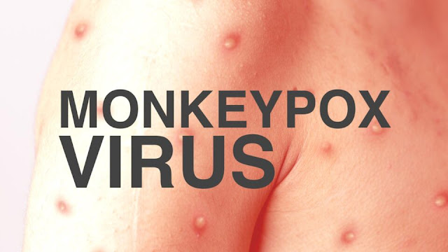 Monkeypox knocked in Bihar after Delhi? Suspected patient found in Patna