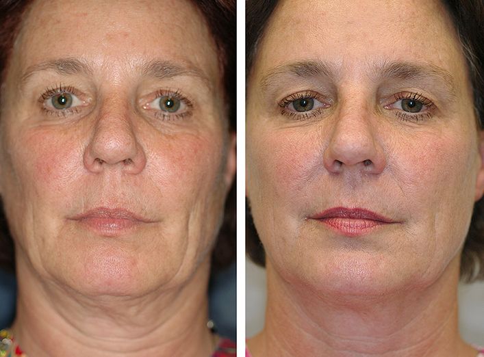 face slimming exercises before and after 0 2