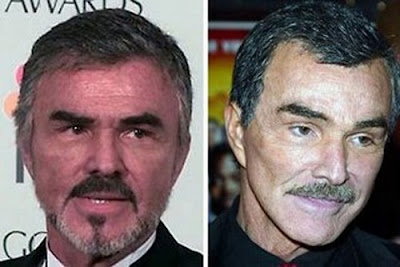 Burt Reynolds - before and after pictures of facelift? (image hosted by plasticcelebritysurgery.com)