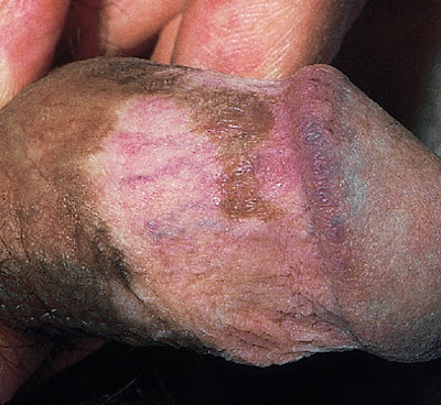 Vitiligo of the penis