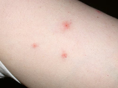 Bed bugs bites