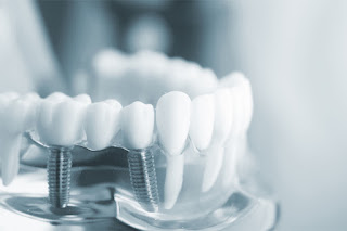 Cấy implant ở đâu tốt-2