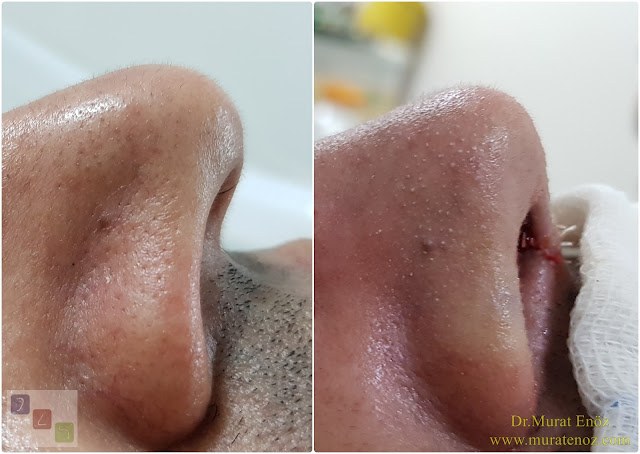 Nose Tip Surgery for Men - Male Nose Tip Plasty Operation in Istanbul - Men's Nose Tip Plasty - Nose Tip Reshaping For Men - Mens Nose Tip Plasty in Turkey - Nose Tip Plasty For Men - Nose Tip Plasty For Men Istanbul - Nose Tip Aesthetic for Men - Male Nose Tip Plasty Operation - Male Nose Tip Plasty Surgery in Istanbul - Male Nose Tip Plasty Surgery in Turkey - Male Nose Tip Aesthetic Surgery - Nose Tip Plasty In Mens Istanbul