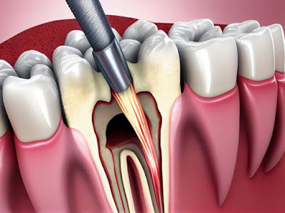 Dental Aesthetics & Root Canal Treatment in Gurgaon