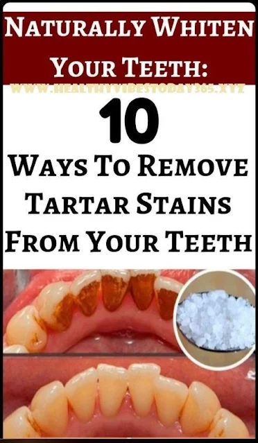 10 Ways To Remove Tartar Stains From You Teeth