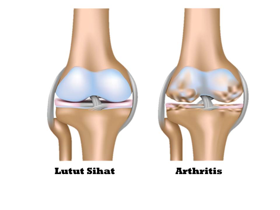 Ubat Sakit Lutut Sendi: PENAWAR SAKIT LUTUT DAN SENDI