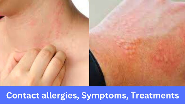 Know about Contact allergies, Symptoms, Treatments, Safety, & Skin Health Tips