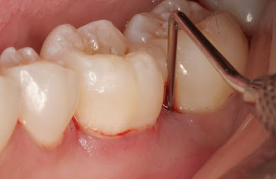 Chảy máu chân răng sau khi lấy cao răng không đáng lo ngại 1