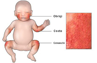 Informatii medicale despre dermatita atopica