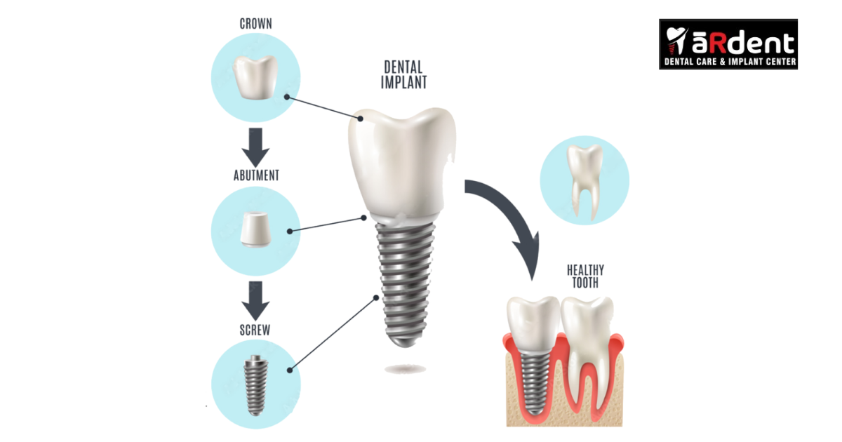 The Advanced Technique For Immediate Loading Implants