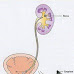 RIRS: A Minimally Invasive Procedure for kidney stone treatment 