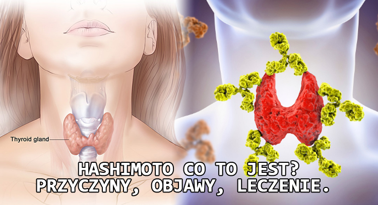 Hashimoto co to jest? Przyczyny, objawy, leczenie.